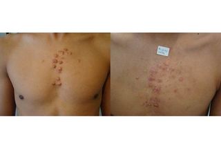 queloide