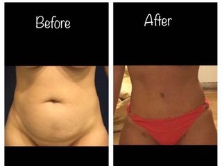 Abdominoplastia