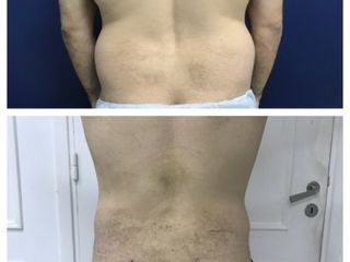 LIPOESCULTURA
