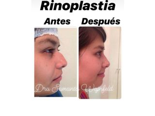 rinoplastia -antes y despues-