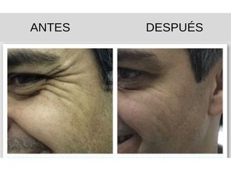 Botox - 636104