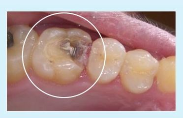 Cerámica dental