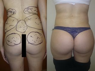 liposucción con aumento glúteo