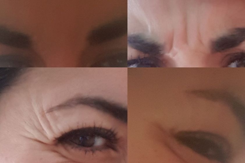 Botox antes y después - 637997