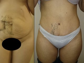 Pre post abdominoplastia con reconstrucción de pared abdominal
