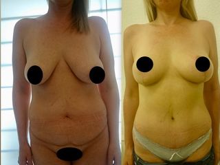 Pre post Pexia mamaria con abdominoplastia