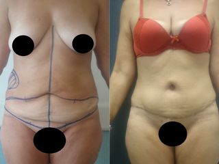 abdominoplastia pos bariátrica