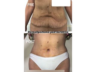 Dermolipectomía - Dr. Monjo Hugo Luciano