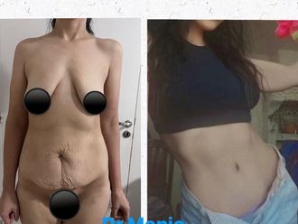 Abdominoplastía antes y después - 867221