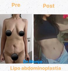 Abdominoplastia - Dr. Hugo Monjo