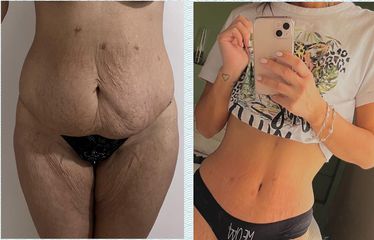 Abdominoplastia - Dr. Hugo Monjo