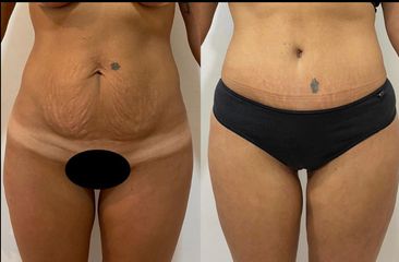 Abdominoplastia  - Dr. Hugo Monjo