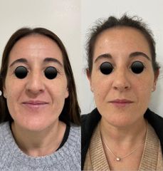 Rinoplastia - Dr. Hugo Monjo