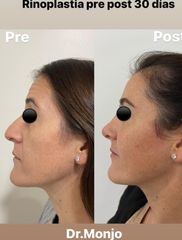 Rinoplastia  - Dr. Hugo Monjo