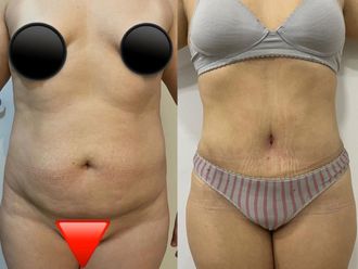 Liposucción antes y después - 867229