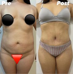 Lipo Abdominoplastia - Dr. Hugo Monjo