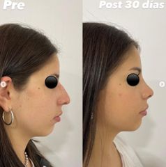 Rinoplastia -  Dr. Hugo Monjo