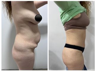 Abdominoplastia - Dr. Monjo Hugo Luciano