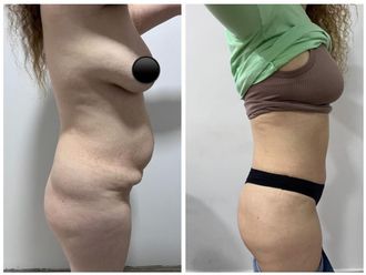Dermolipectomía antes y después - 869943
