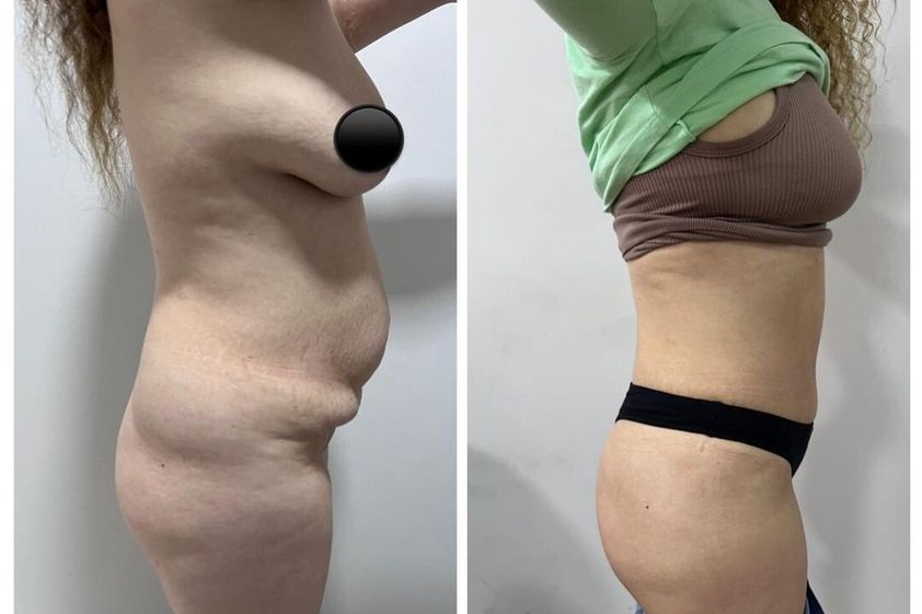 Dermolipectomía antes y después - 869943
