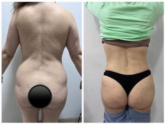 Dermolipectomía antes y después - 869944