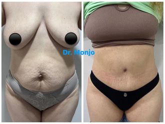 Abdominoplastía antes y después - 869945