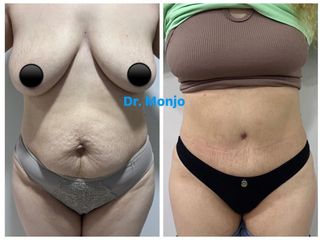 Abdominoplastia - Dr. Monjo Hugo Luciano