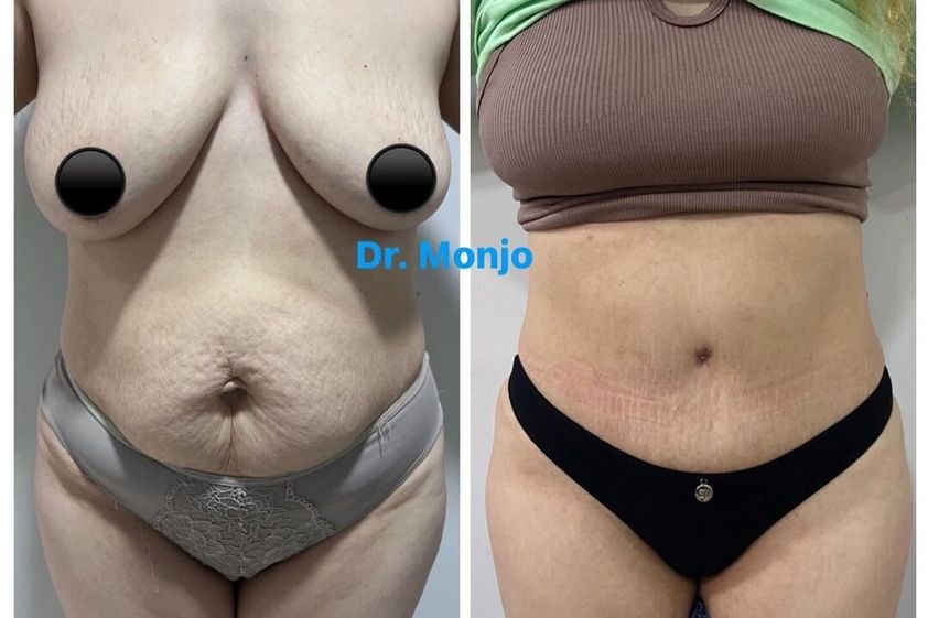 Dermolipectomía antes y después - 869945