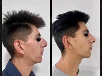 Rinoplastia antes y después - 876173