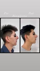 Rinoplastia - Dr. Monjo Hugo Luciano
