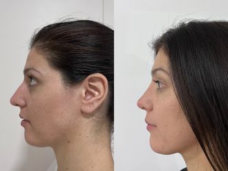 Rinoplastia antes y después - 876175