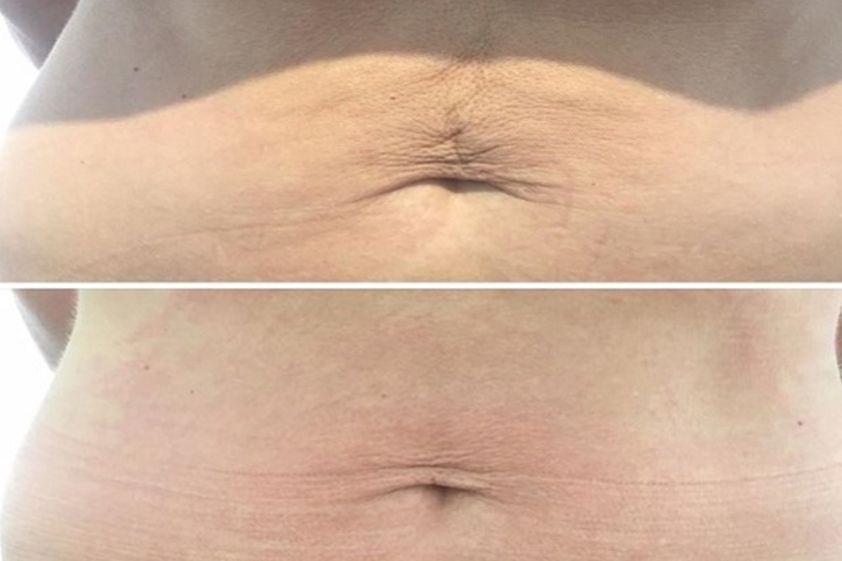 Radiofrecuencia antes y después - 619377