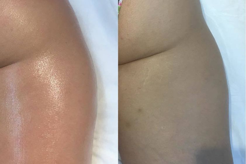 Tratamientos celulitis antes y después - 621284
