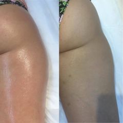 Foto antes y despues velaslim