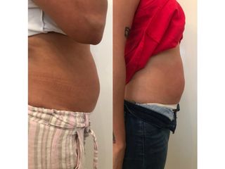 antes y despues reductor