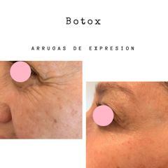 Botox 