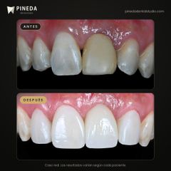 Diseño de sonrisa con carillas y corona - Pineda Dental Studio