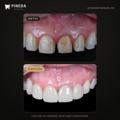 Carillas de porcelana diseñadas en 3D - Pineda Dental Studio