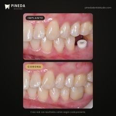 Implante dental con corona cerámica - Pineda Dental Studio