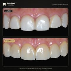 Carillas de cerámica - Pineda Dental Studio