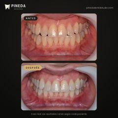 Blanqueamiento con láser de diodo - Pineda Dental Studio