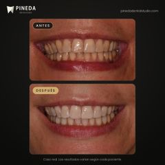 Blanqueamiento dental - Pineda Dental Studio