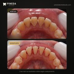 Limpieza dental profesional - Pineda Dental Studio