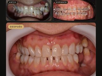 Ortodoncia antes y después - 881708