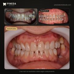 Ortodoncia con brackets de zafiro - Pineda Dental Studio