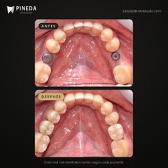 Implantes con coronas - Pineda Dental Studio