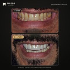 Carillas dentales sin desgaste - Pineda Dental Studio