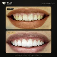 Diseño de sonrisa - Pineda Dental Studio