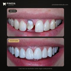 Estética dental con carillas - Pineda Dental Studio