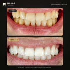 Blanqueamiento dental - Pineda Dental Studio
